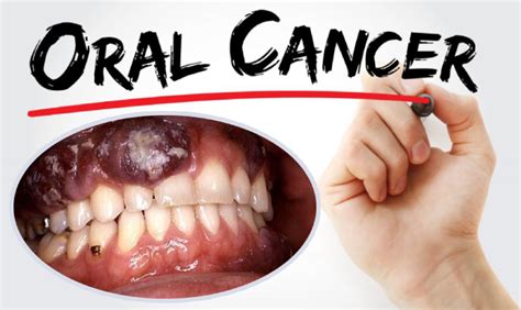 cancer bucal - cancer de tireoide sintomas